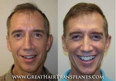 hair transplant cost