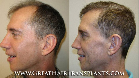 hair restoration