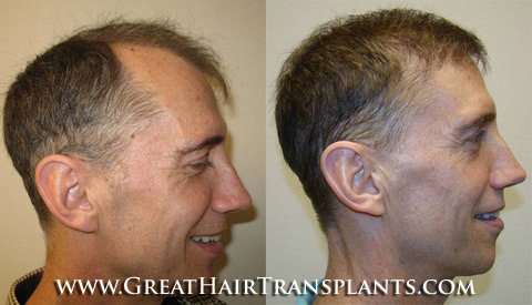 affordable hair transplants