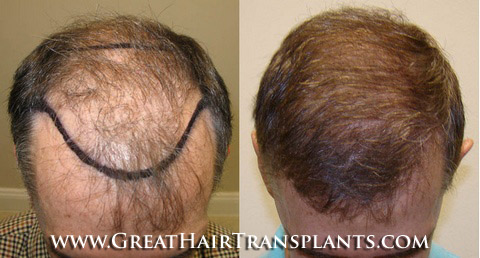 hair transplants cost
