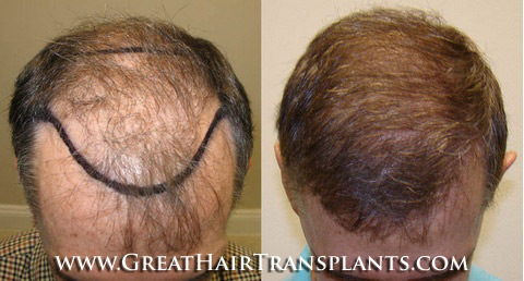 hair transplants