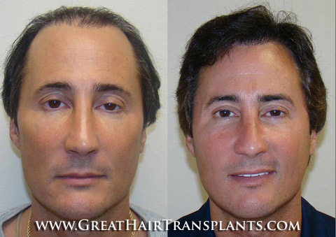 hair transplant