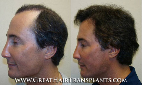 affordable hair transplants