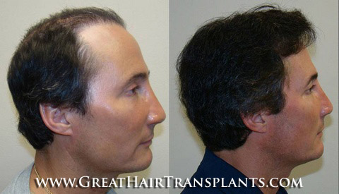 hair transplant cost