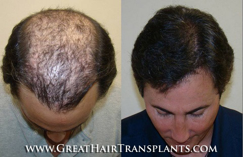 hair transplants