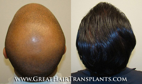 hair transplants cost