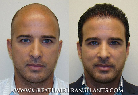 affordable hair transplants