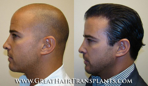 hair transplants cost