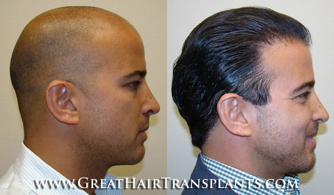 hair restoration