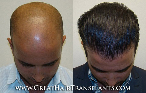 affordable hair transplants