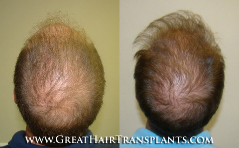 hair transplant cost