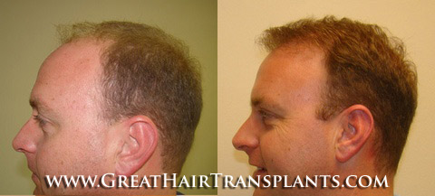 hair transplants