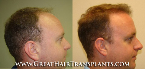 affordable hair transplants