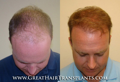 hair transplant