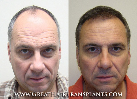 affordable hair transplants