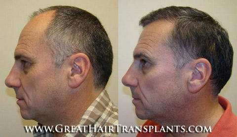 hair transplant cost