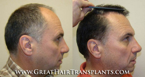 hair transplant cost