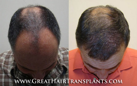 affordable hair transplants