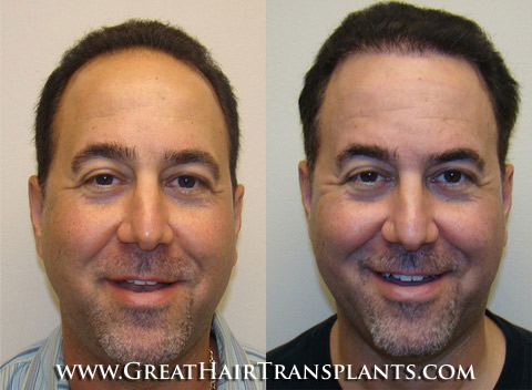 hair transplant surgery