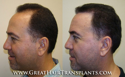 hair restoration