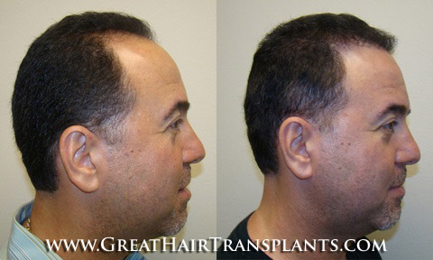 hair transplant surgery