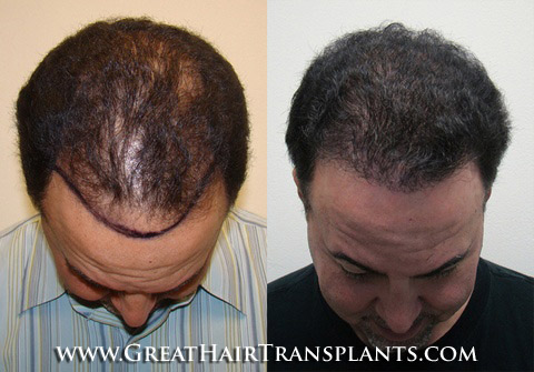 affordable hair transplants