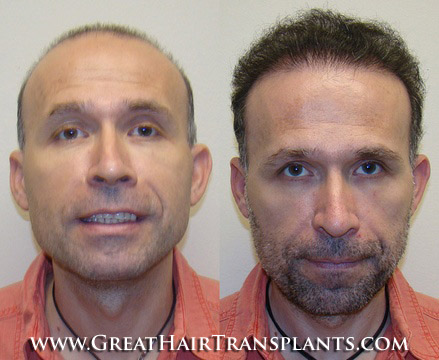 hair restoration