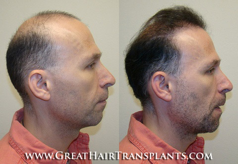 hair transplants