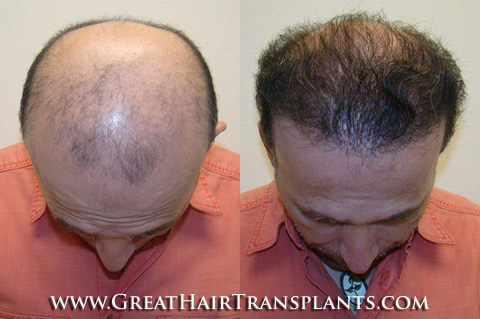 hair transplant cost