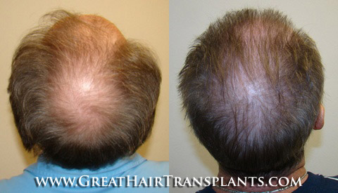 hair implantation