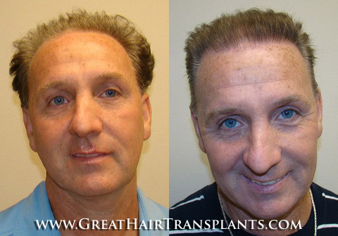 hair transplants