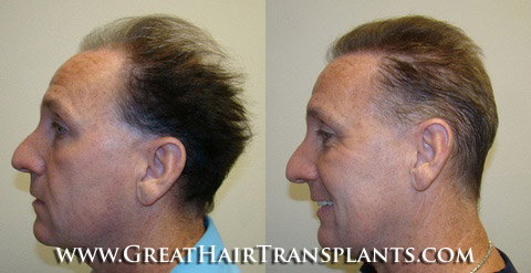 hair transplant