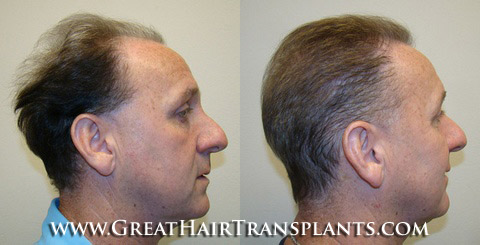 low cost hair transplant