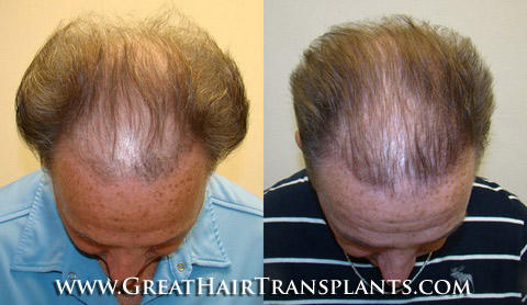 hair transplants cost