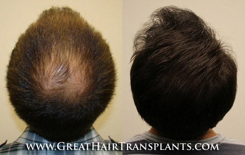 hair restoration