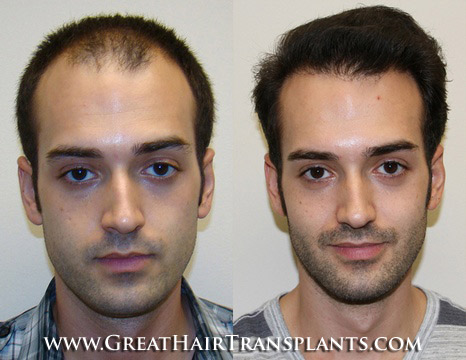 hair transplants