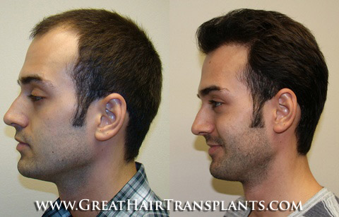 hair transplant