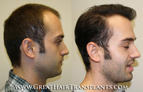 hair transplants cost