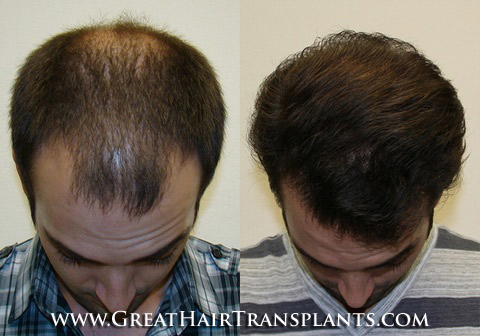 hair restoration