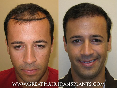 low cost hair transplant