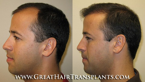 hair transplant