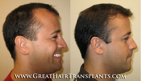 hair transplants