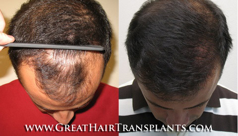 hair transplant cost