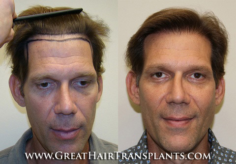 hair transplants cost