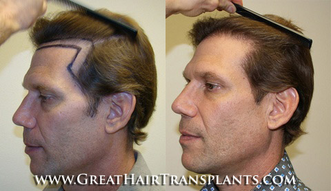 hair transplant