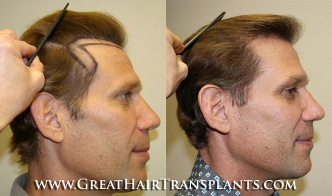 affordable hair transplants