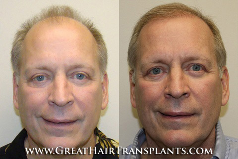 hair transplants