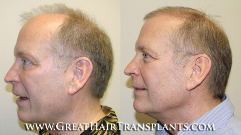 hair restoration